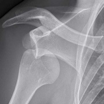 röntgen akut axelluxation