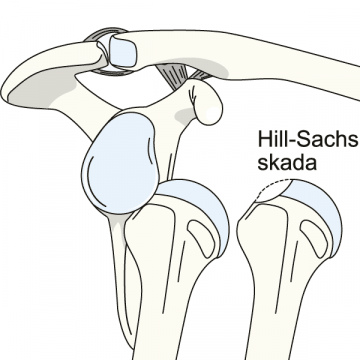 Hill-Sachsskada efter axelluxation