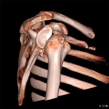 datortomografi axelluxation