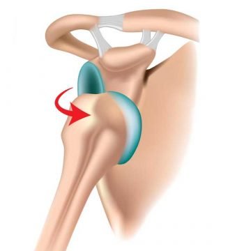 Axeln kan vridas ur led