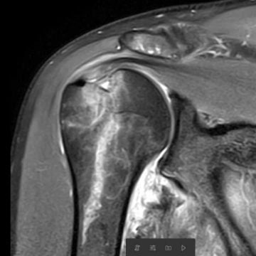 magnetkamera axelluxation